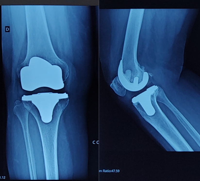 Ilustração de artroplastia de joelho