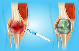Ilustração de infiltração nas articulações