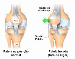 Ilustração de instabilidade patelar