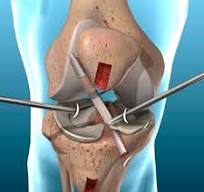 Ilustração de lesão ligamentar no joelho