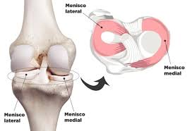Ilustração de lesão no menisco