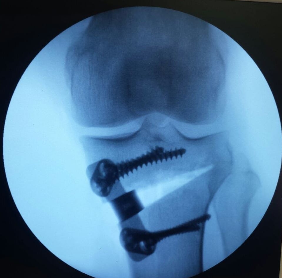 Ilustração de lesão no menisco